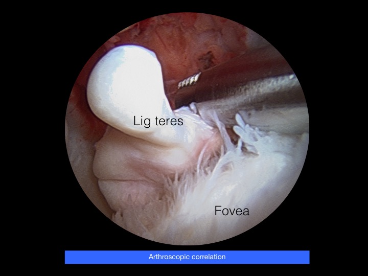 Figure 3 for case ligamentum teres of femoral head ( RID2653 )